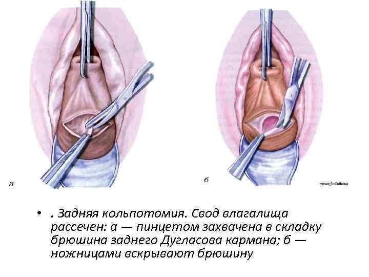 Обрезанный Влагалища Фото