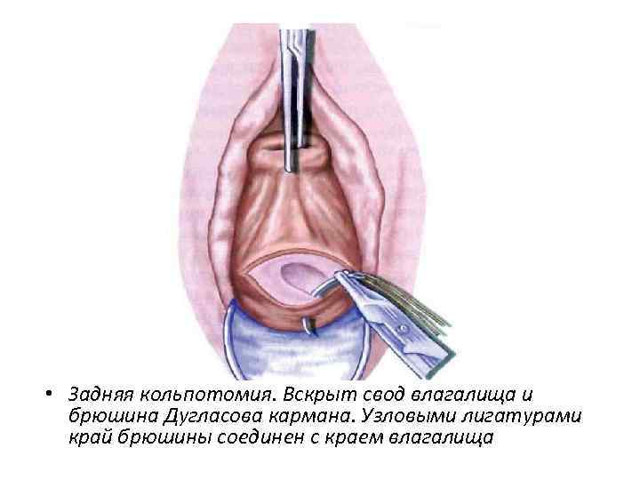 Своды Влагалища Фото