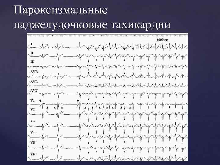 Пароксизмальные наджелудочковые тахикардии 