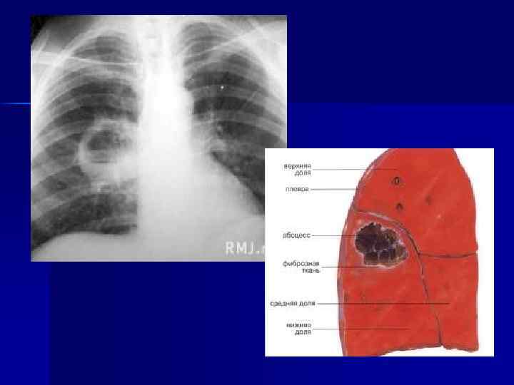 Абсцесс легкого фото