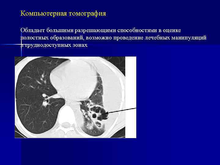 Компьютерная томография Обладает большими разрешающими способностями в оценке полостных образований, возможно проведение лечебных манипуляций