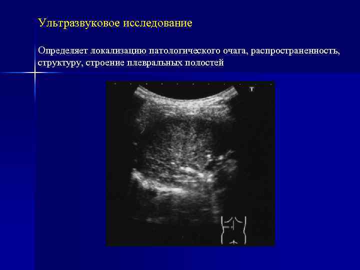 Ультразвуковое исследование Определяет локализацию патологического очага, распространенность, структуру, строение плевральных полостей 