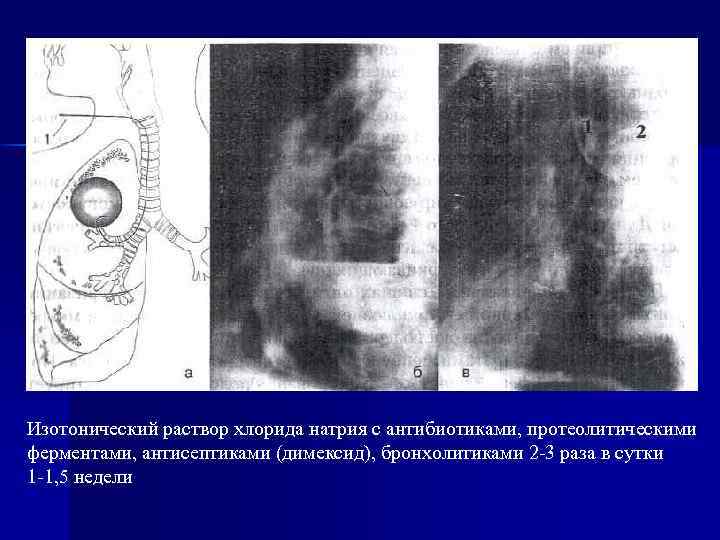 Изотонический раствор хлорида натрия с антибиотиками, протеолитическими ферментами, антисептиками (димексид), бронхолитиками 2 -3 раза