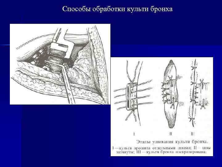 Способы обработки культи бронха 