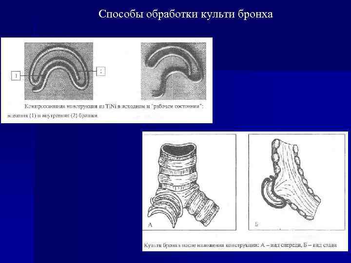 Способы обработки культи бронха 