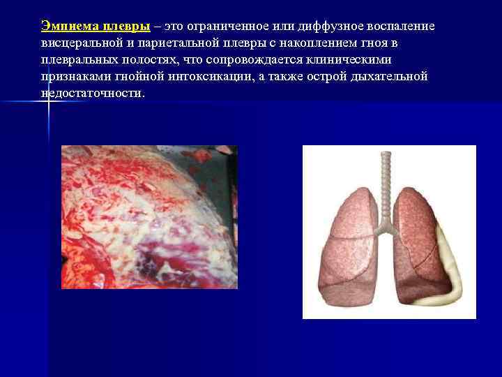 Эмпиема плевры – это ограниченное или диффузное воспаление висцеральной и париетальной плевры с накоплением