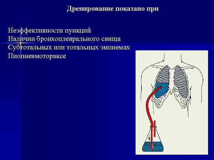 Дренирование показано при Неэффективности пункций Наличии бронхоплеврального свища Субтотальных или тотальных эмпиемах Пиопневмотораксе 