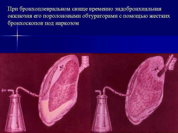 При бронхоплевральном свище временно эндобронхиальная окклюзия его поролоновыми обтураторами с помощью жестких бронхоскопов под