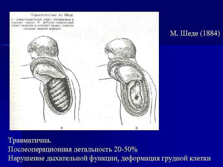 М. Шеде (1884) Травматична. Послеоперационная летальность 20 -50% Нарушение дыхательной функции, деформация грудной клетки