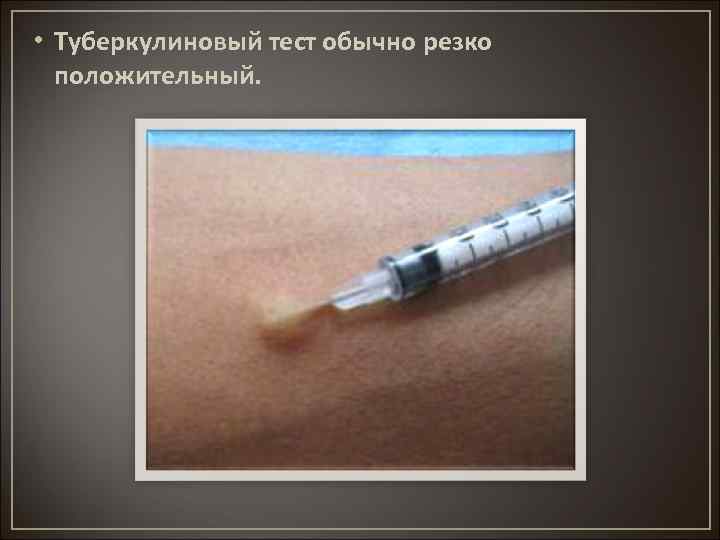  • Туберкулиновый тест обычно резко положительный. 