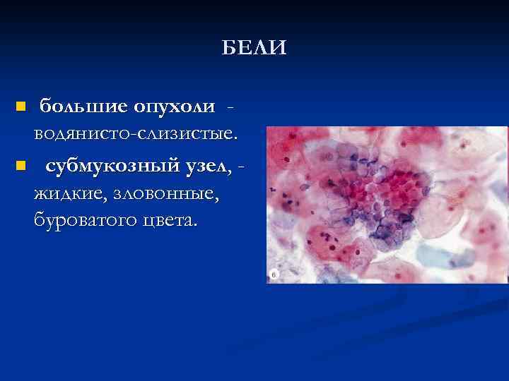 БЕЛИ большие опухоли водянисто-слизистые. n субмукозный узел, жидкие, зловонные, буроватого цвета. n 