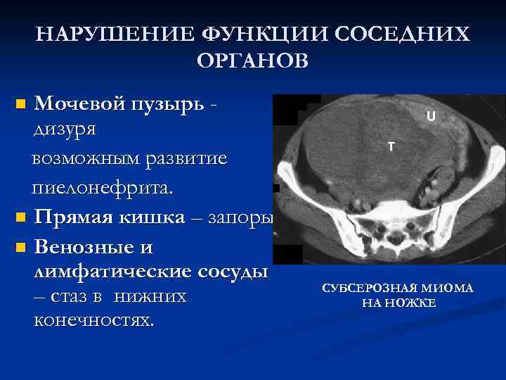 НАРУШЕНИЕ ФУНКЦИИ СОСЕДНИХ ОРГАНОВ Мочевой пузырь дизуря возможным развитие пиелонефрита. n Прямая кишка –