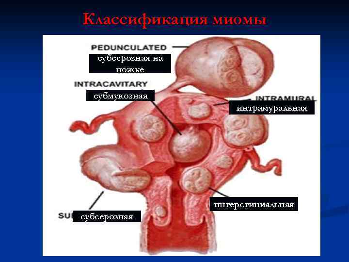 Классификация миомы субсерозная на ножке субмукозная интрамуральная интерстициальная субсерозная 