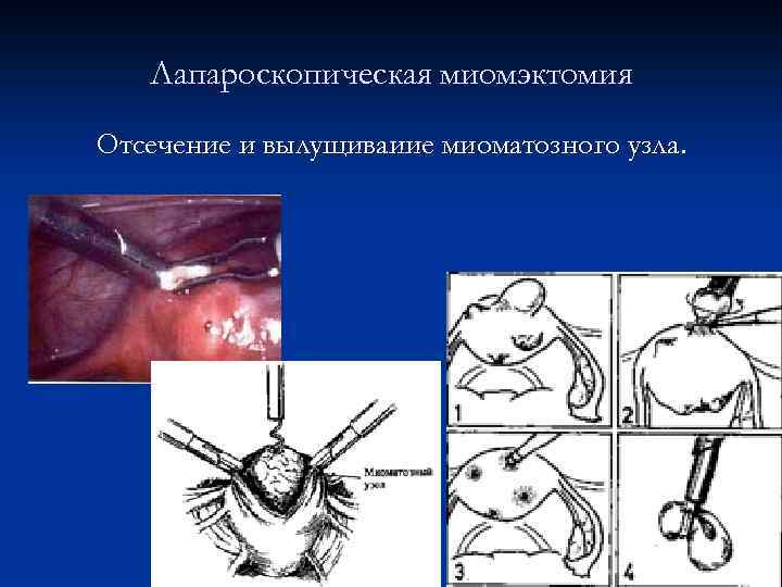 Лапароскопическая миомэктомия Отсечение и вылущиваиие миоматозного узла. 