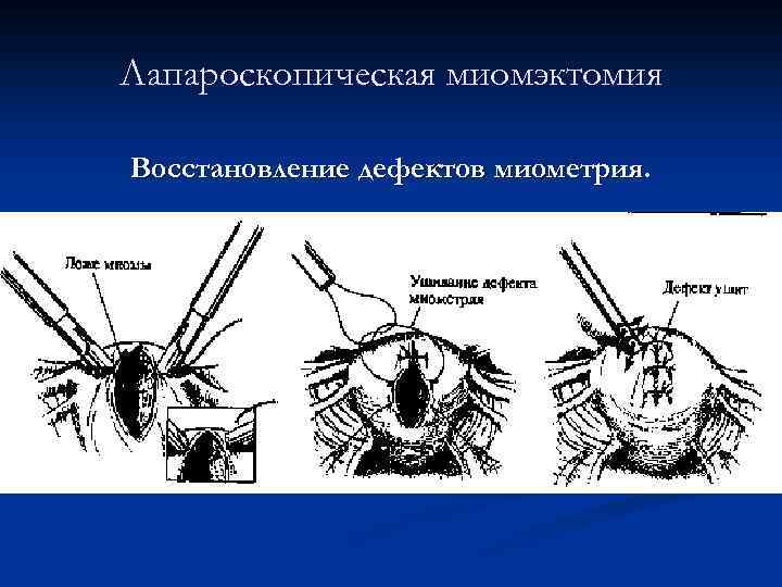 Лапароскопическая миомэктомия Восстановление дефектов миометрия. 