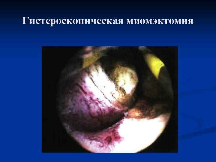 Гистероскопическая миомэктомия 