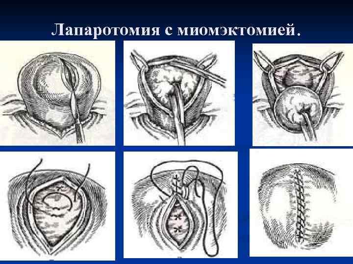 Лапаротомия с миомэктомией. 