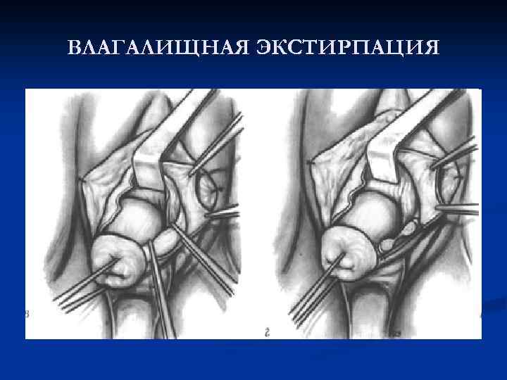 ВЛАГАЛИЩНАЯ ЭКСТИРПАЦИЯ 