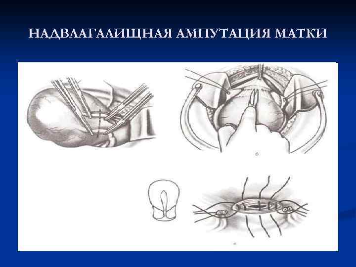 НАДВЛАГАЛИЩНАЯ АМПУТАЦИЯ МАТКИ 