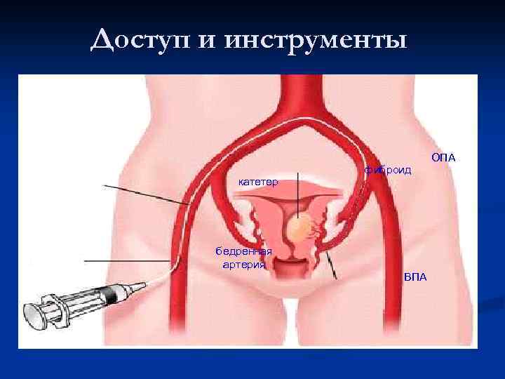 Доступ и инструменты ОПА ПБА катетер бедренная артерия фиброид ОПА маточная ВПА артерия 