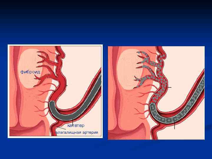 фиброид катетер влагалищная артерия 