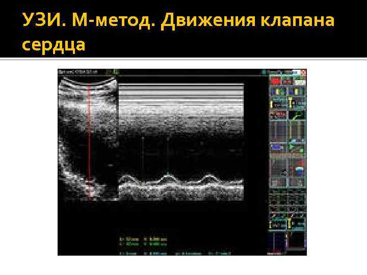 УЗИ. М-метод. Движения клапана сердца 