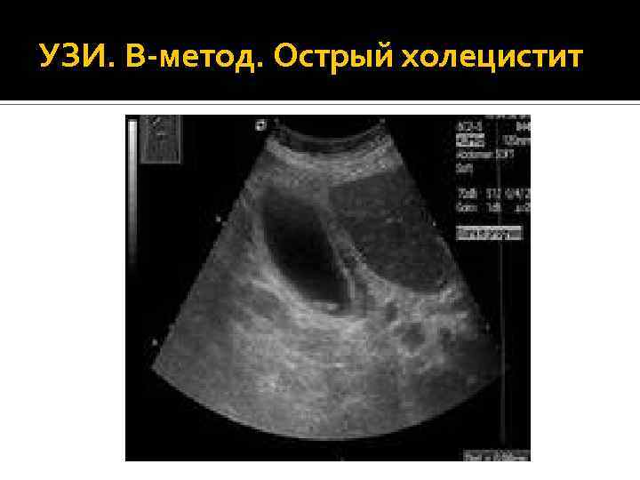 УЗИ. В-метод. Острый холецистит 