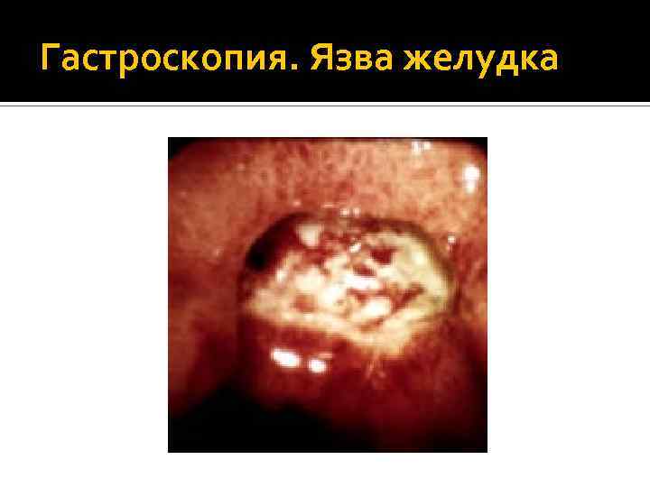 Гастроскопия. Язва желудка 