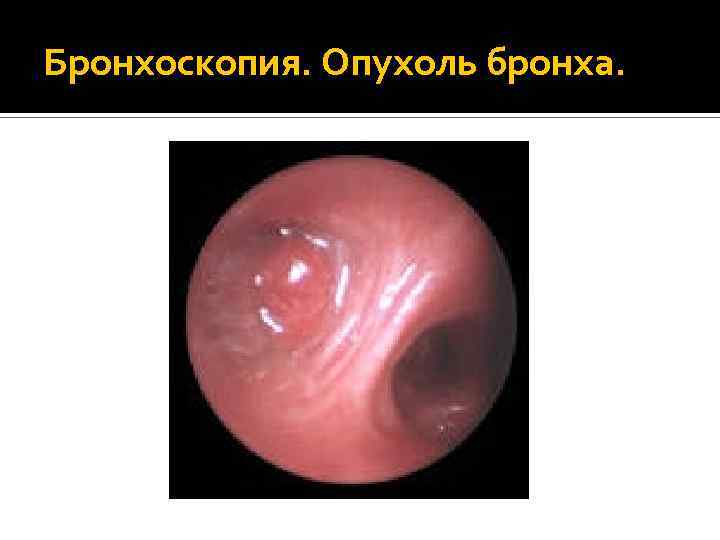 Бронхоскопия. Опухоль бронха. 