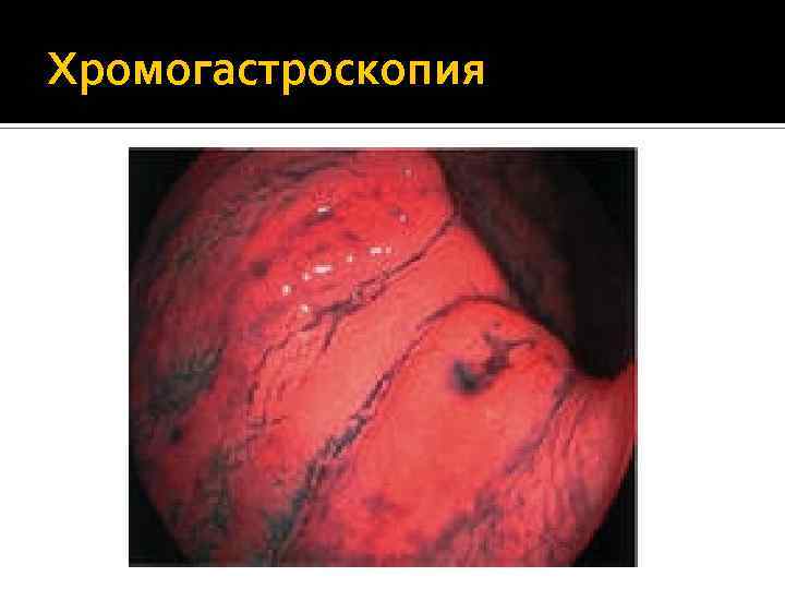 Хромогастроскопия 