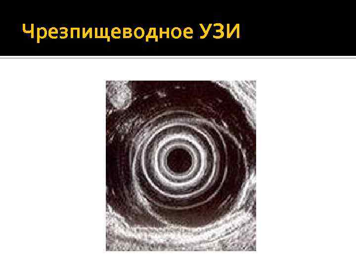 Чрезпищеводное УЗИ 