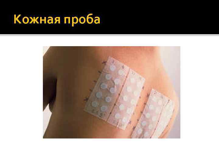 Кожная проба 