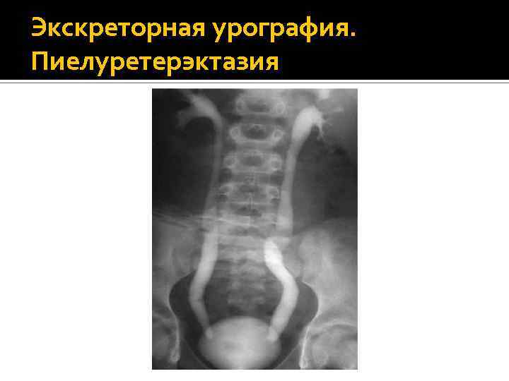 Экскреторная урография. Пиелуретерэктазия 