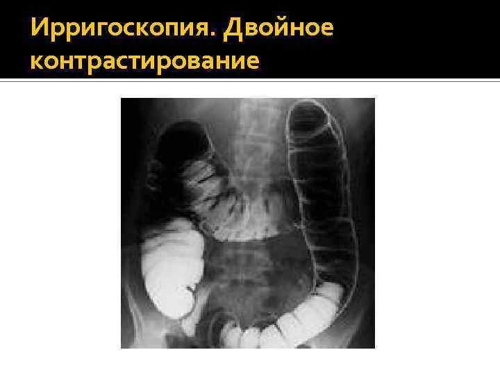 Ирригоскопия. Двойное контрастирование 