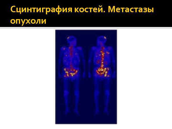 Сцинтиграфия костей. Метастазы опухоли 