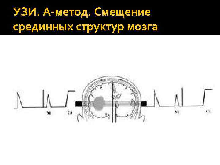 УЗИ. А-метод. Смещение срединных структур мозга 