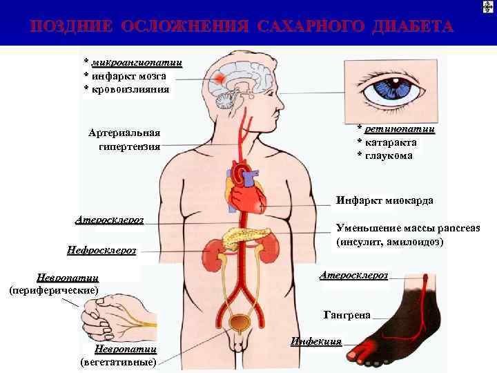 ПОЗДНИЕ ОСЛОЖНЕНИЯ САХАРНОГО ДИАБЕТА * микроангиопатии * инфаркт мозга * кровоизлияния * ретинопатии *