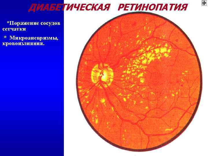 ДИАБЕТИЧЕСКАЯ РЕТИНОПАТИЯ *Поражение сосудов сетчатки * Микроаневризмы, кровоизлияния. 