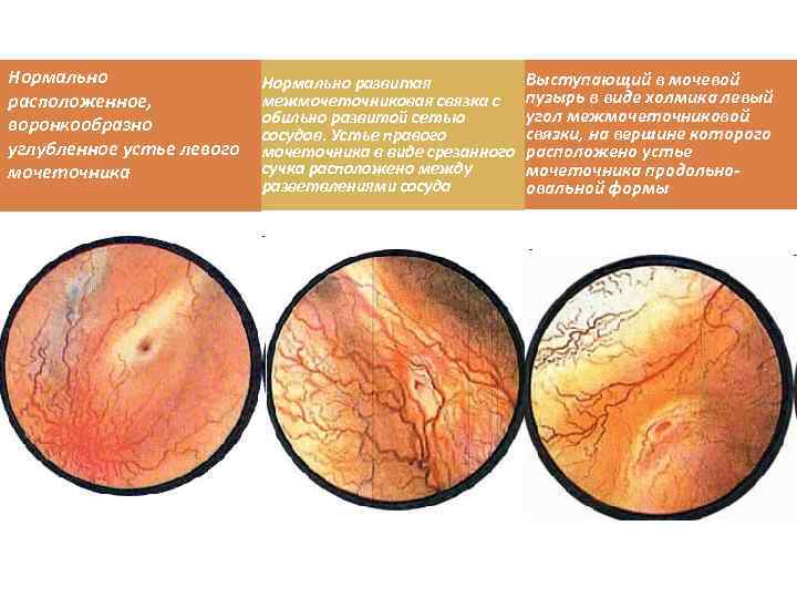 Нормально расположенное, воронкообразно углубленное устье левого мочеточника Нормально развитая межмочеточниковая связка с обильно развитой