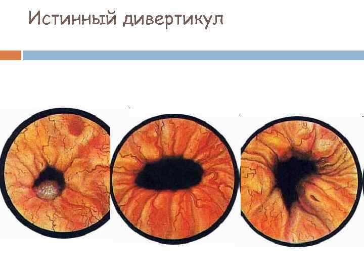 Истинный дивертикул 