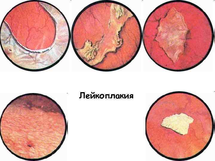 Лейкоплакия 