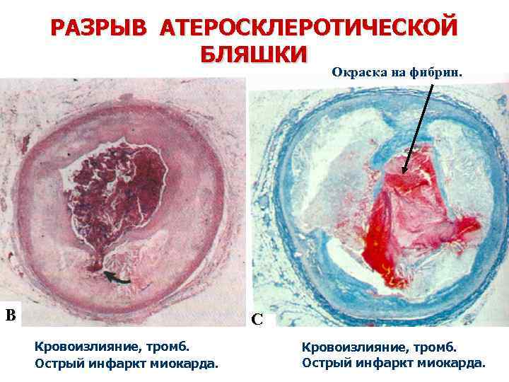 РАЗРЫВ АТЕРОСКЛЕРОТИЧЕСКОЙ БЛЯШКИ Окраска на фибрин. В С Кровоизлияние, тромб. Острый инфаркт миокарда. 