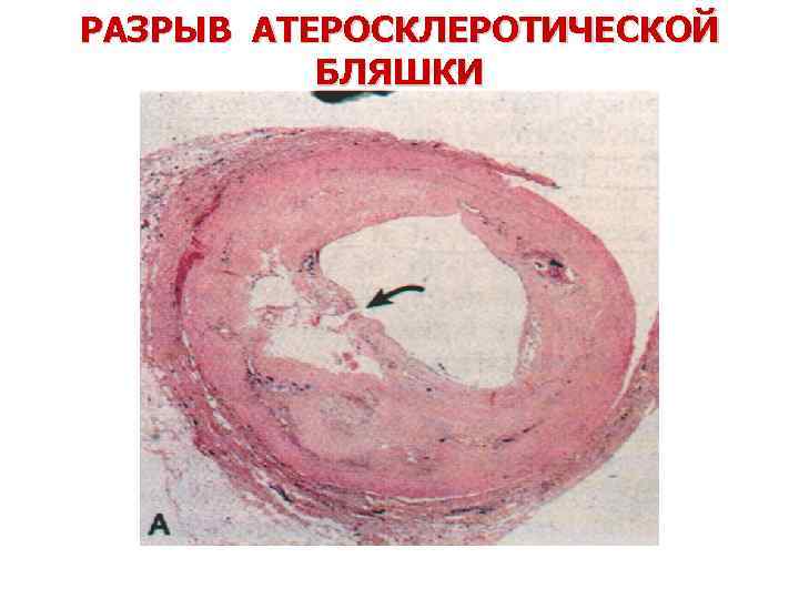 РАЗРЫВ АТЕРОСКЛЕРОТИЧЕСКОЙ БЛЯШКИ 