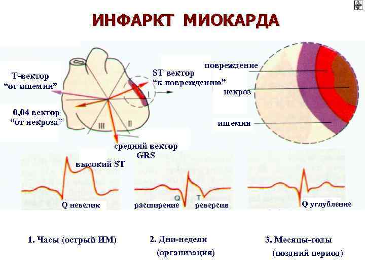 Презентация ишемия инфаркт миокарда