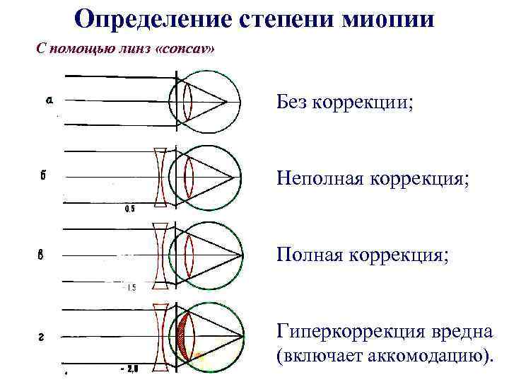Определение степени миопии С помощью линз «concav» Без коррекции; Неполная коррекция; Полная коррекция; Гиперкоррекция