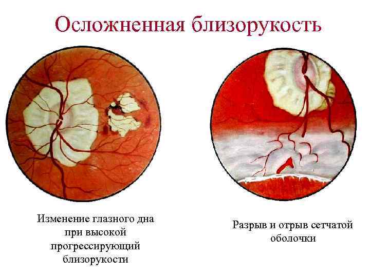Осложненная близорукость Изменение глазного дна при высокой прогрессирующий близорукости Разрыв и отрыв сетчатой оболочки