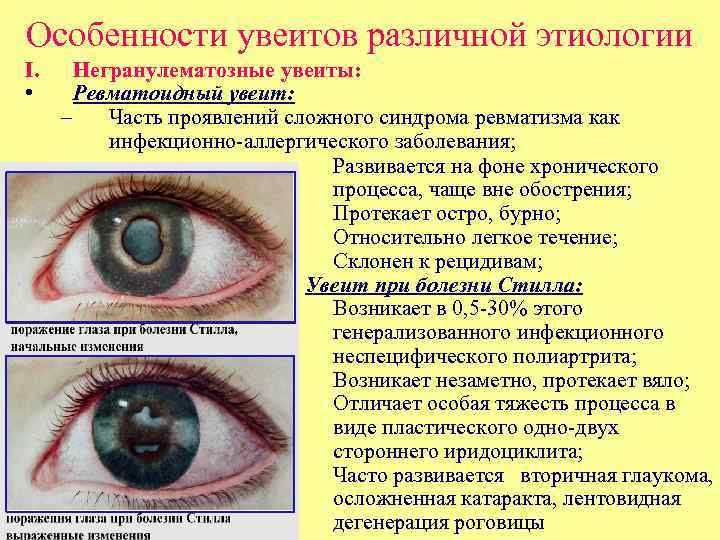 Особенности увеитов различной этиологии I. • Негранулематозные увеиты: Ревматоидный увеит: – Часть проявлений сложного