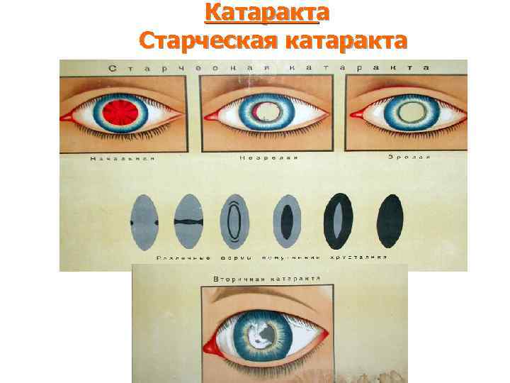 Катаракта Старческая катаракта 