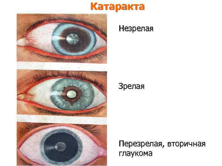 Катаракта Незрелая Зрелая Перезрелая, вторичная глаукома 
