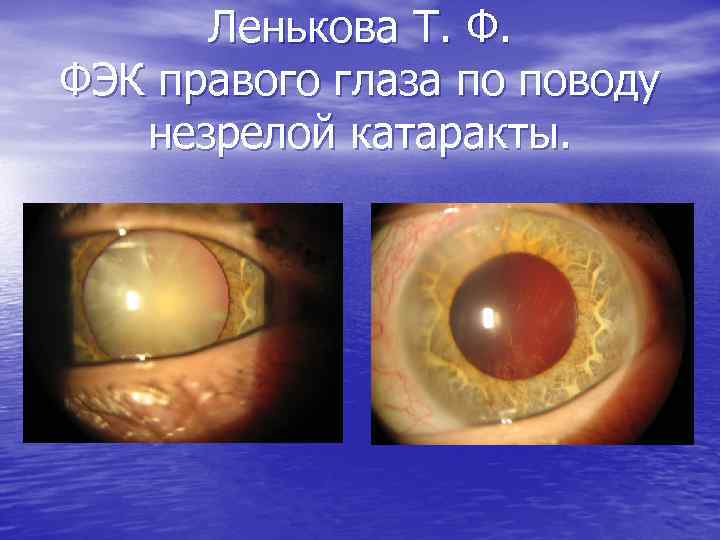 Ленькова Т. Ф. ФЭК правого глаза по поводу незрелой катаракты. 